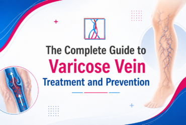 The Complete Guide to Varicose Vein Treatment and Prevention Expert Care